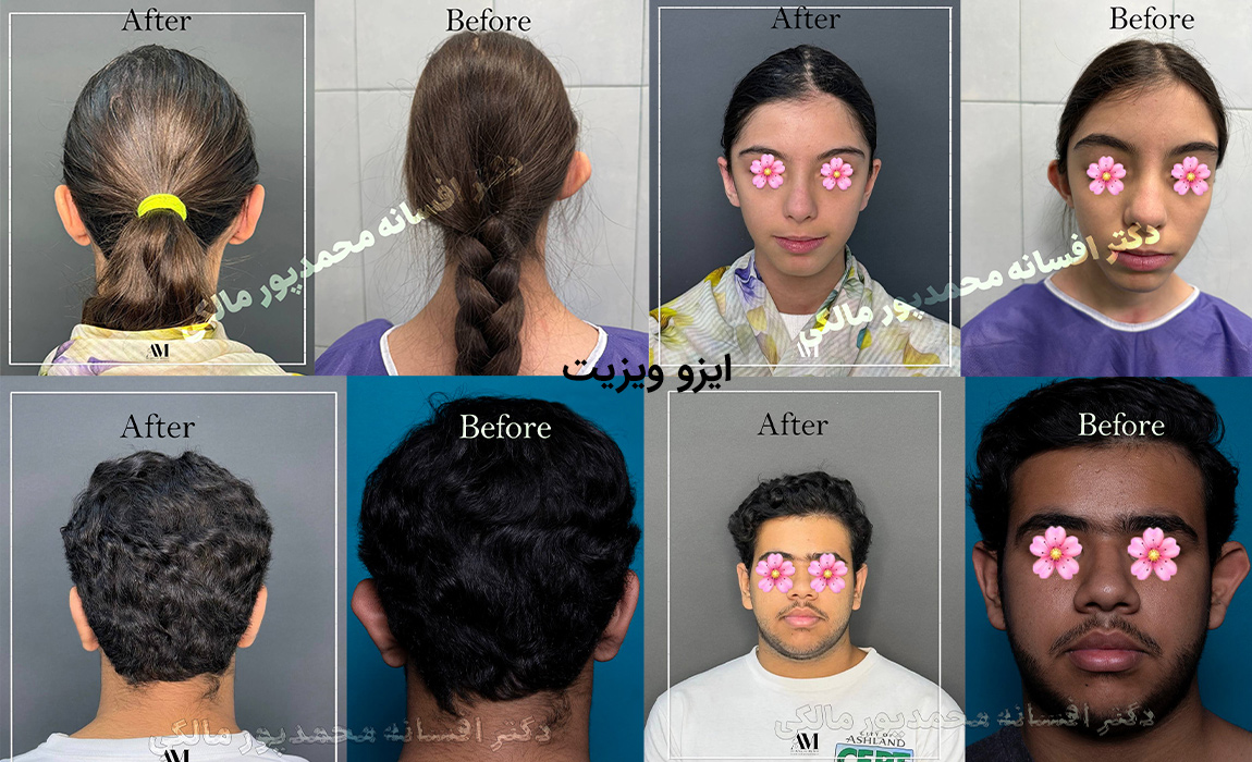 بهترین جراح زیبایی گوش مشهد - افسانه محمد پور مالکی - نمونه کار