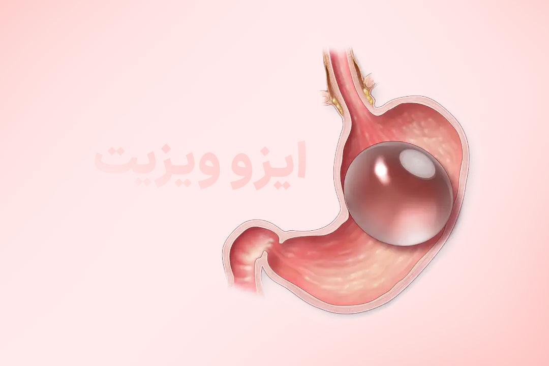 جراحی بالون معده