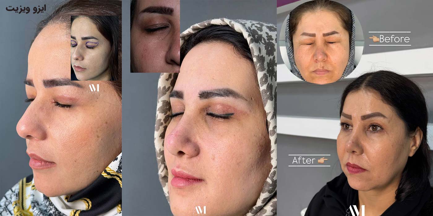 نمونه کارهای جراحی بلفاروپلاستی دکتر افسانه محمدپور مالکی