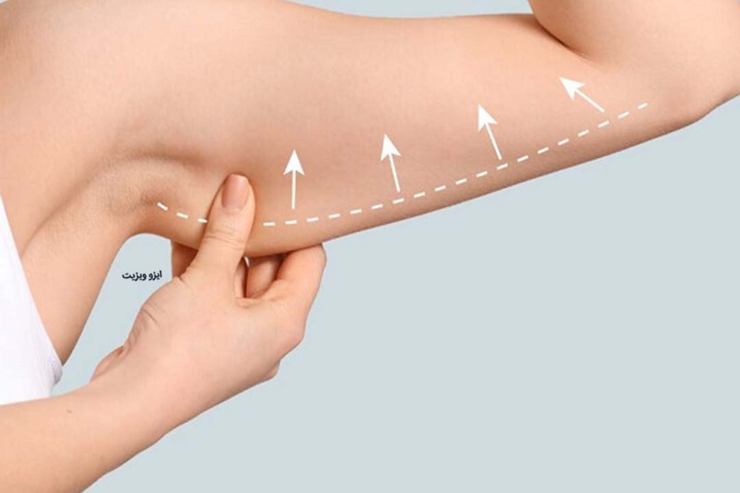 بهترین جراح براکیوپلاستی (لیفت بازو) در تهران |تیم علمی تحقیقاتی ایزوویزیت