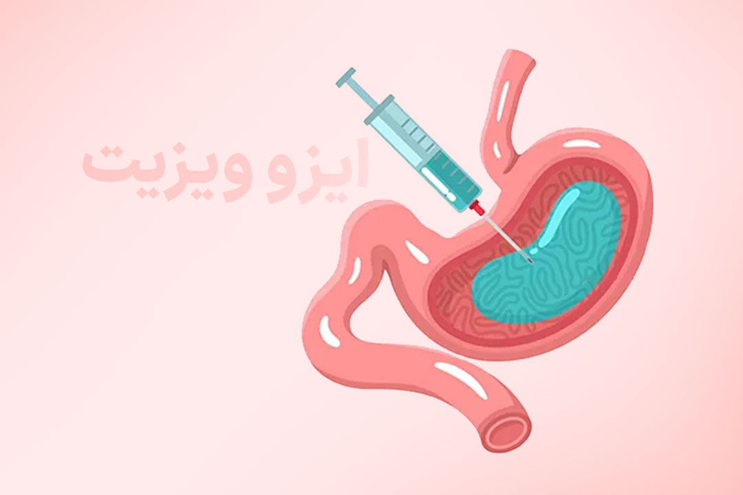 جراحی بوتاکس معده