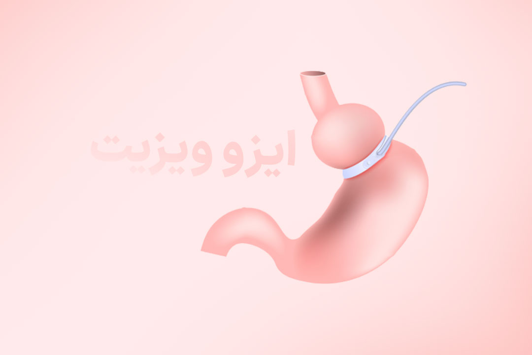 جراحی حلقه معده