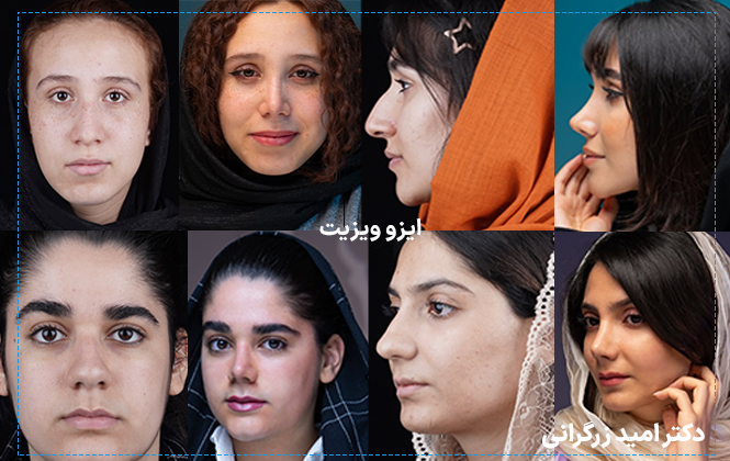 نمونه کارهای جراحی بینی دکتر امید زرگرانی