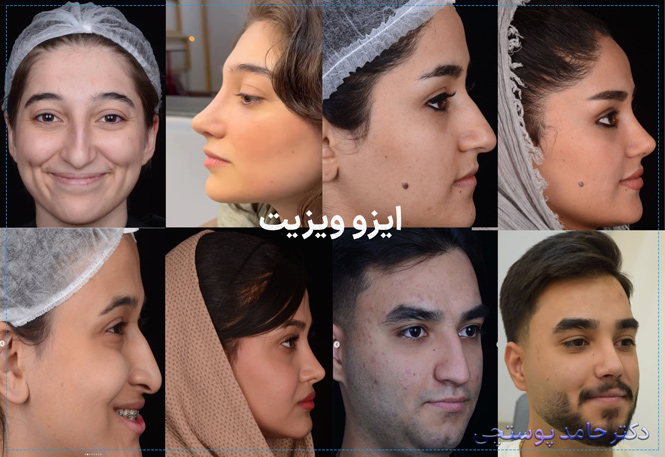 نمونه کارهای جراحی بینی دکتر حامد پوستچی