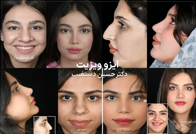 نمونه کارهای جراحی بینی دکتر حسین دستغیب