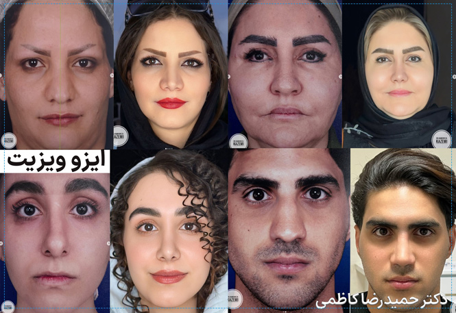 نمونه کارهای جراحی بینی دکتر حمیدرضا کاظمی