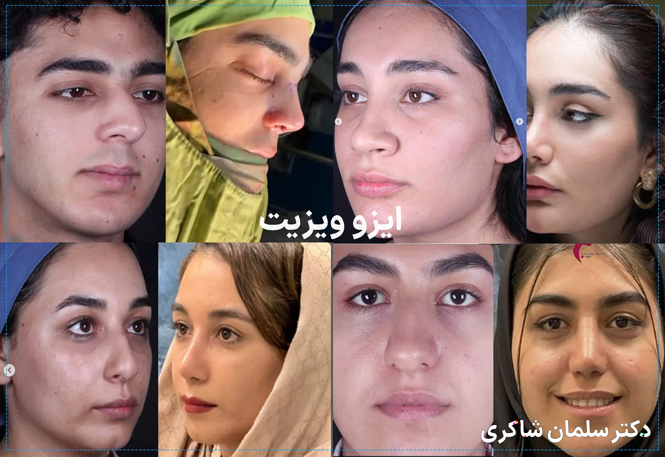 نمونه کارهای جراحی بینی دکتر سلمان شاکری