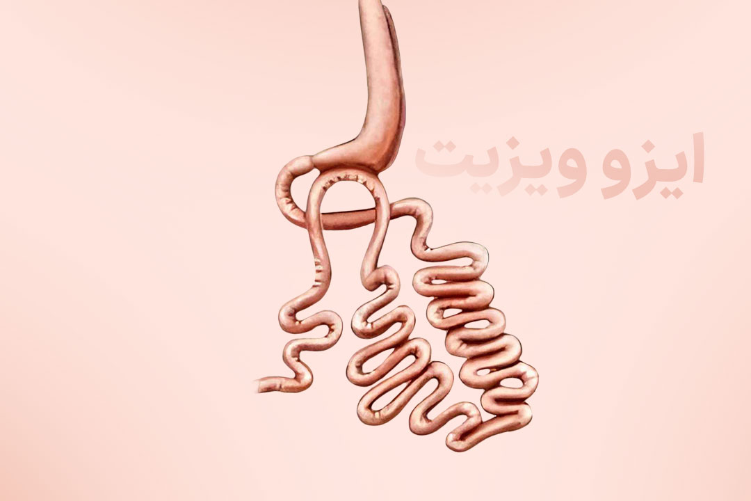 جراحی ساسج معده