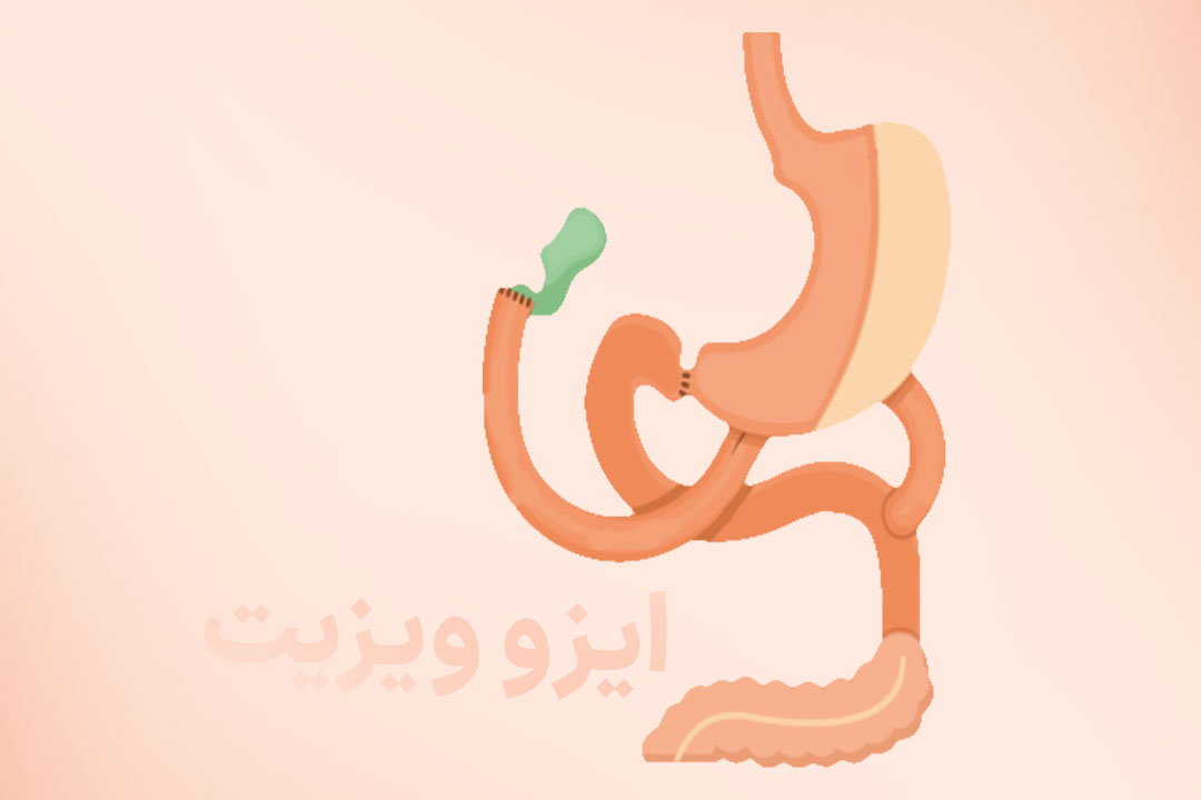جراحی معده سوئیچ دوازدهه