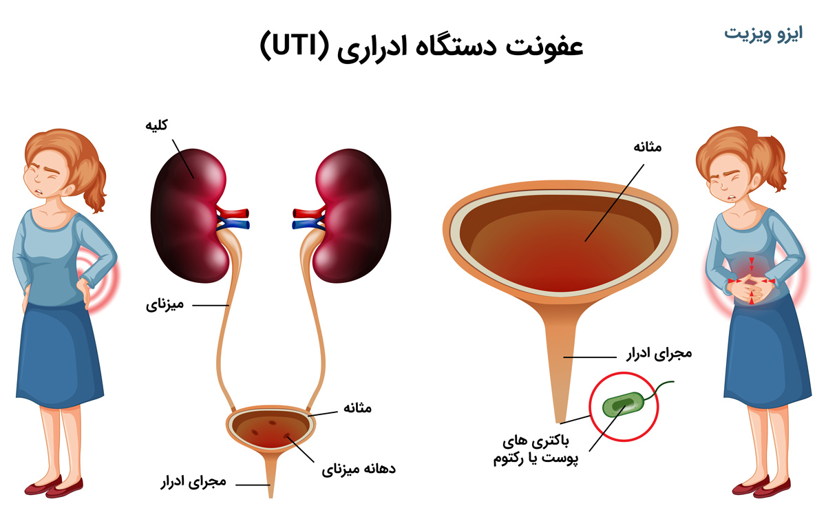 عفونت ادراری 
