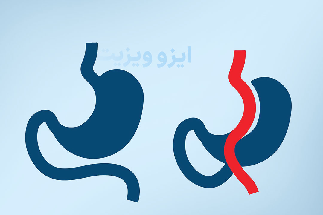 جراحی مینی بای پس معده