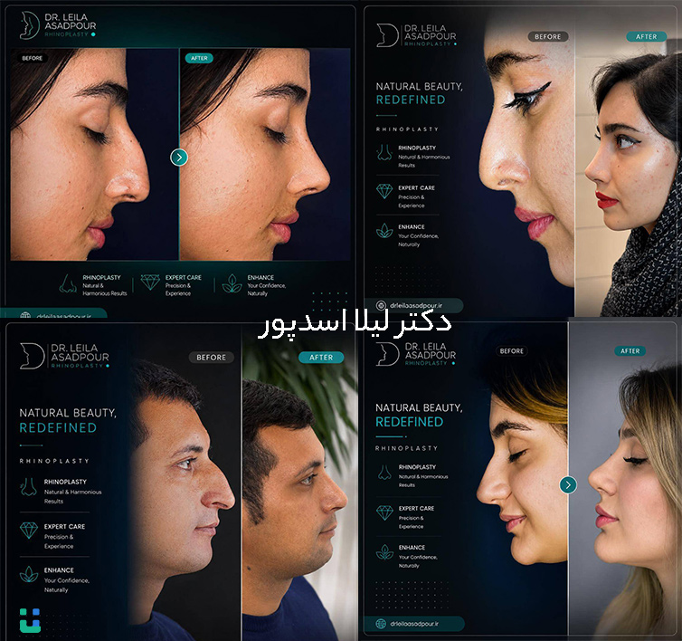 نمونه عمل بینی دکتر لیلا اسدپور