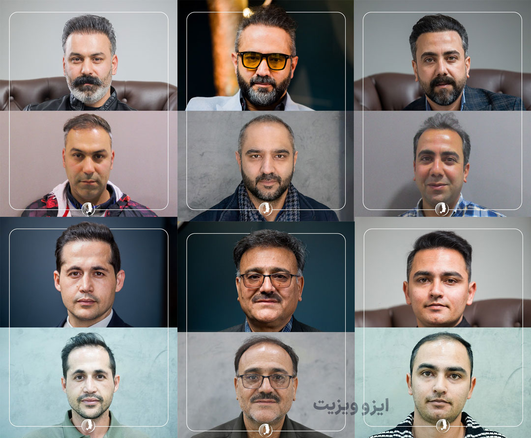 نمونه کاشت مو کلینیک نوین ایرانا - بهترین کلینیک کاشت مو مشهد