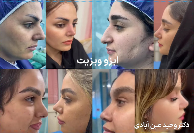 نمونه کارهای جراحی بینی دکتر وحید عین آبادی