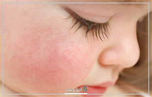 شایع ترین مشکلات پوستی در کودکان