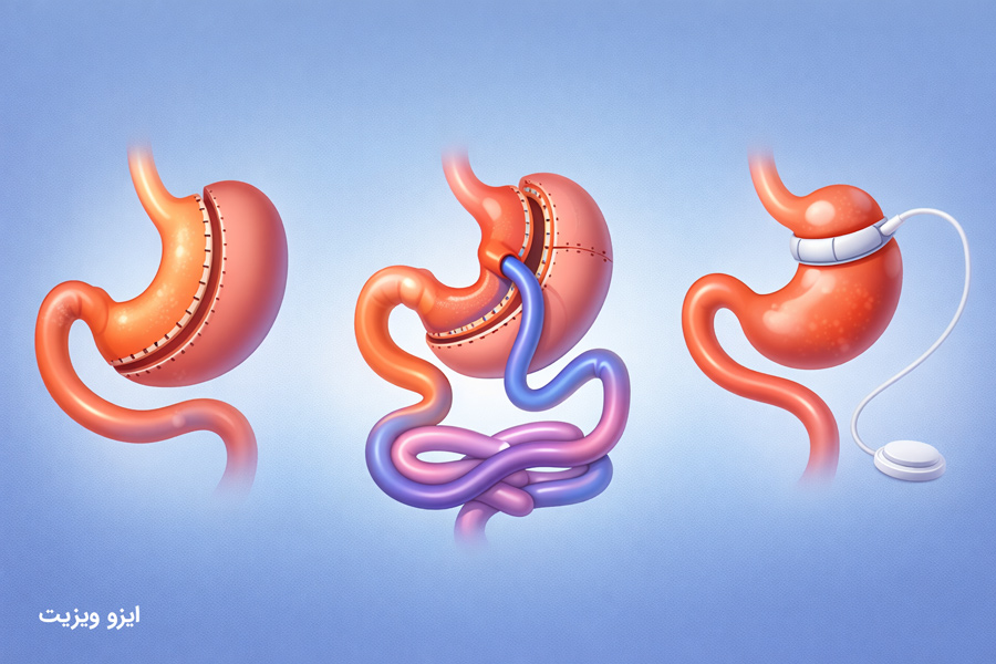 تاثیر عمل چاقی بر درمان آپنه خواب