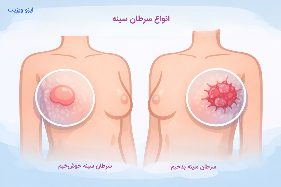 مقایسه سرطان سینه خوش خیم و بدخیم