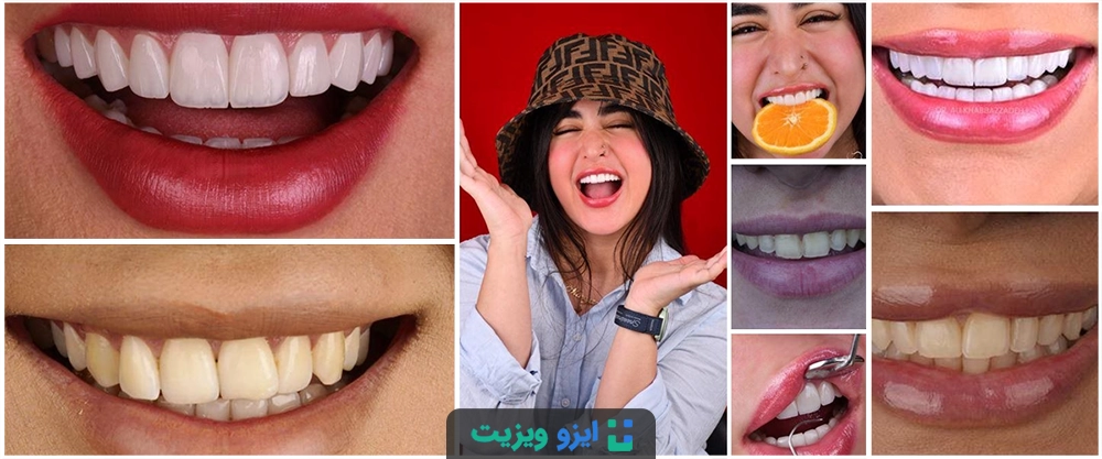 نمونه کارهای لمینت دندان دکتر علی خباززاده
