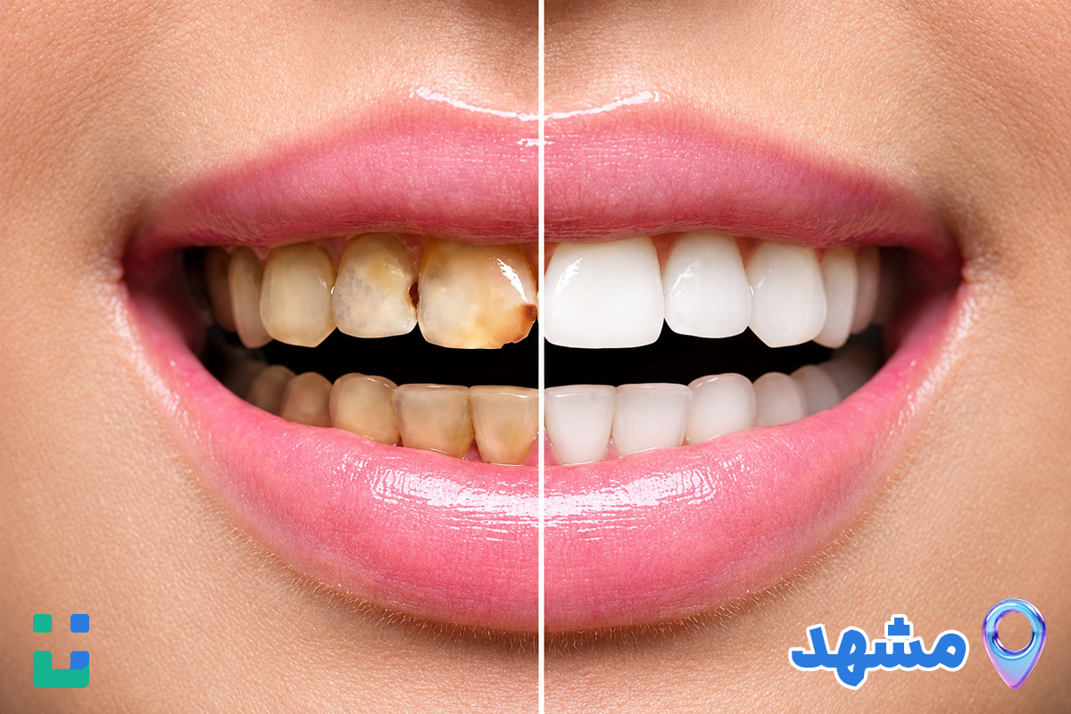 https://dl.isovisit.com/isovisit/uploads/best-laminate-dentists-mashhad-isovisit-online-doctor_1792469964.jpg