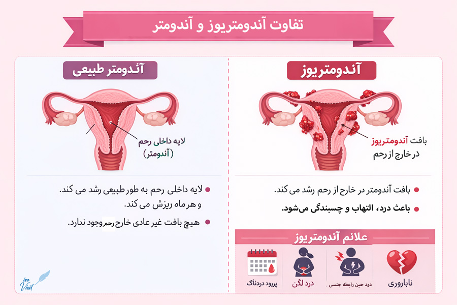 تفاوت آندومتر و آندومتریوز چیست