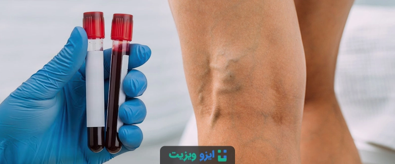 تشخیص واریس پا با استفاده از آزمایش خون