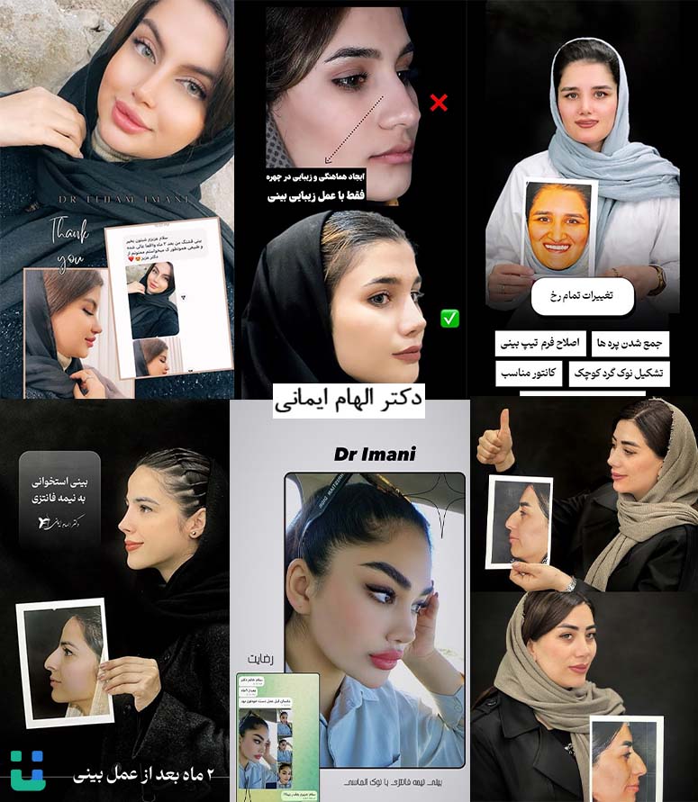 نمونه کارهای عمل بینی دکتر الهام ایمانی