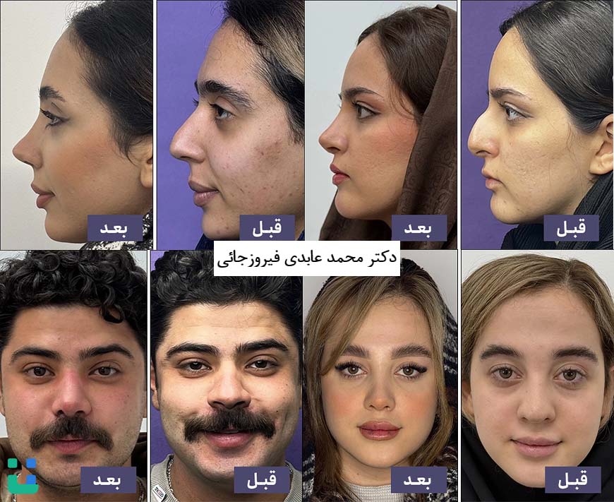 نمونه کارهای عمل بینی دکتر محمد عابدی فیروزجائی