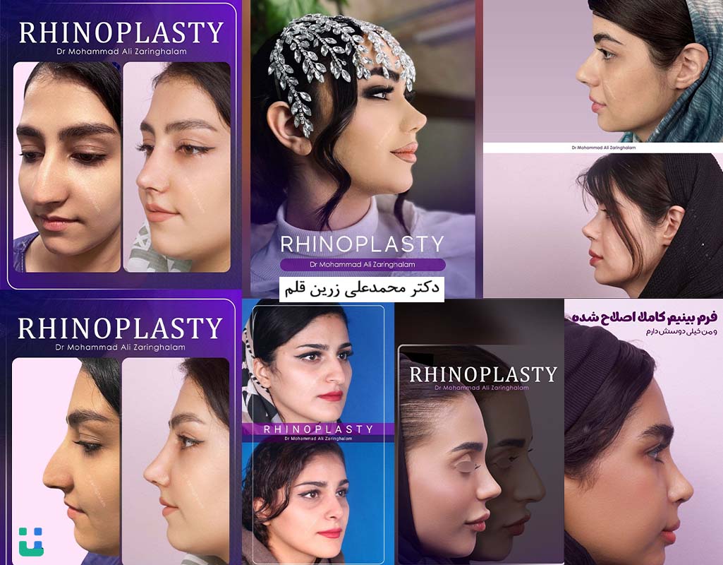 نمونه کارهای عمل بینی دکتر محمدعلی زرین قلم