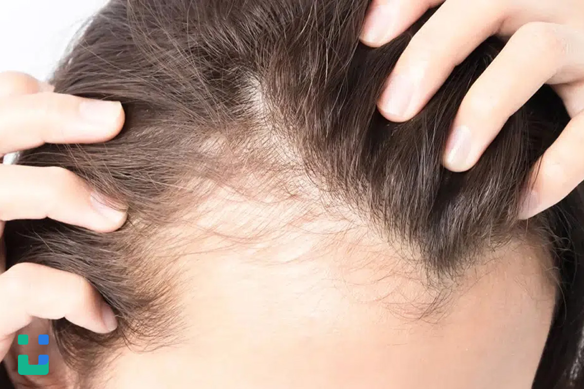 https://dl.isovisit.com/isovisit/uploads/hair-loss-after-rapid-weight-loss-doctor-online-visit_1792303866.jpg