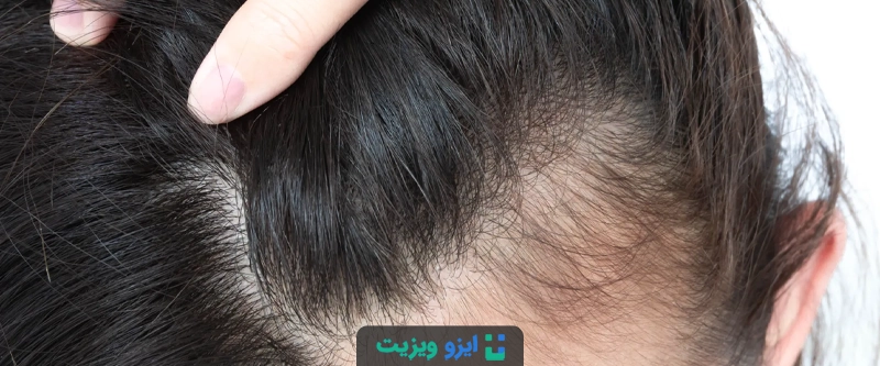 یکی از عوامل کلیدی که به ریزش مو پس از کاهش وزن کمک می کند، کمبودهای تغذیه ای، به ویژه در ویتامین ها و مواد معدنی ضروری برای سلامت مو است.