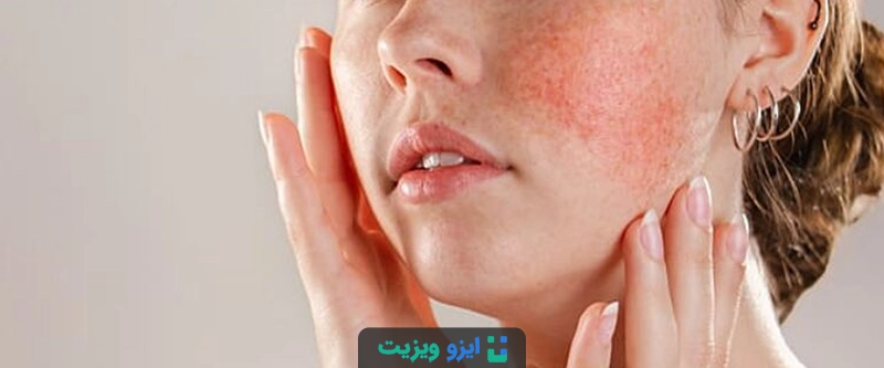 گرگرفتگی یا Hot Flash به احساس ناگهانی و گذرای گرما گفته می&zwnj;شود.