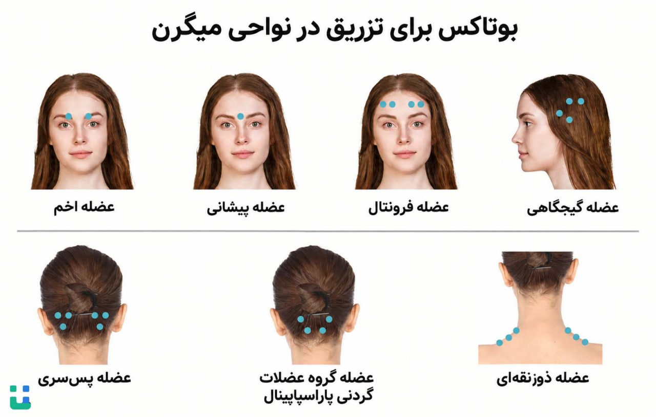 نقاط تزریق بوتاکس میگرن