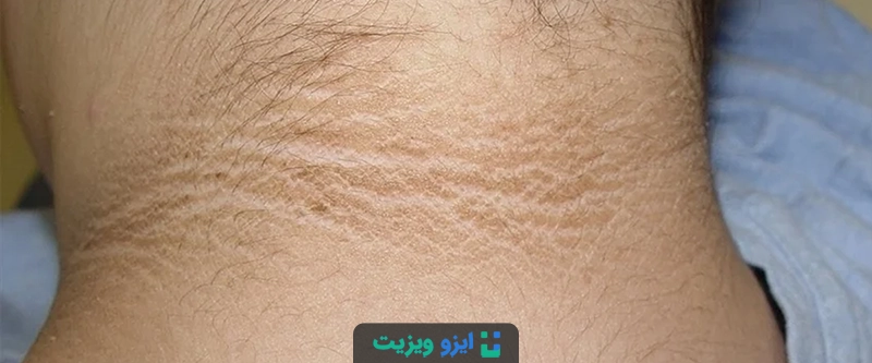علائم مقاومت به انسولین در بدن