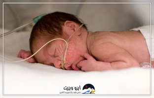 علائمی که نوزادان نارس در بدو تولد دارند