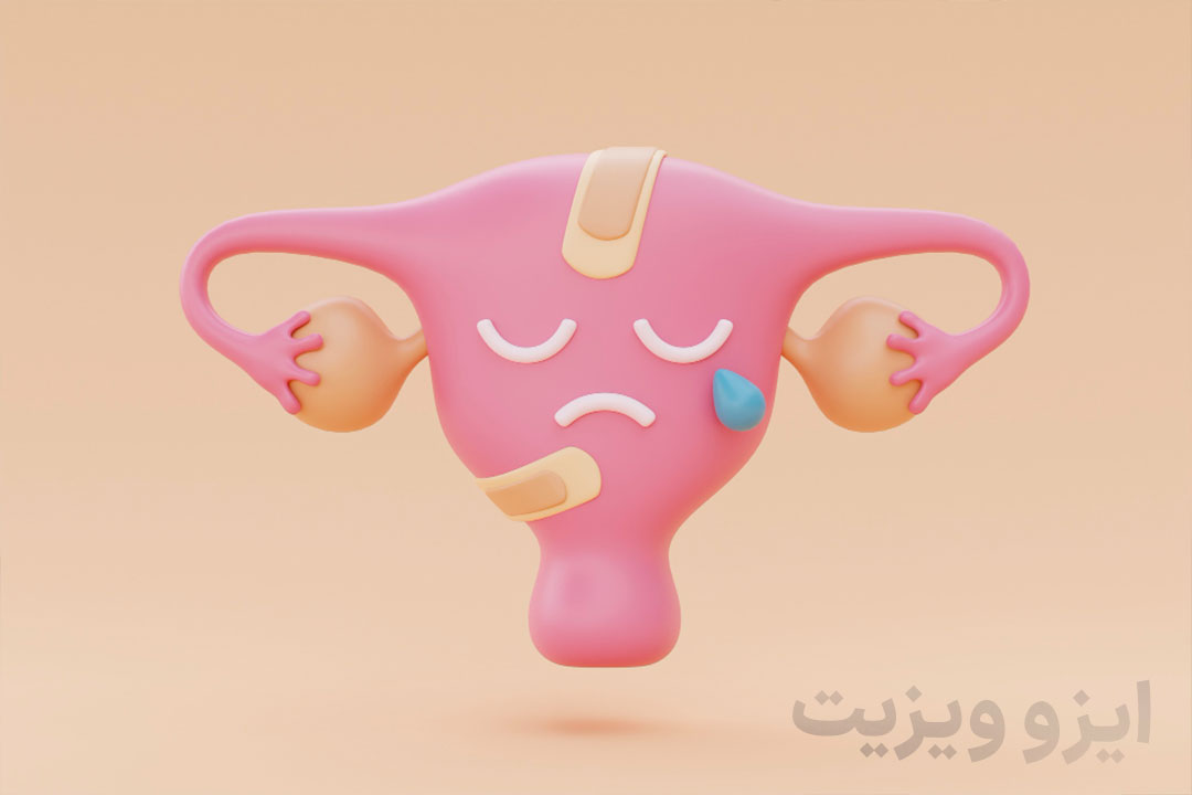 سندرم تخمدان پلی کیستیک (PCOS)
