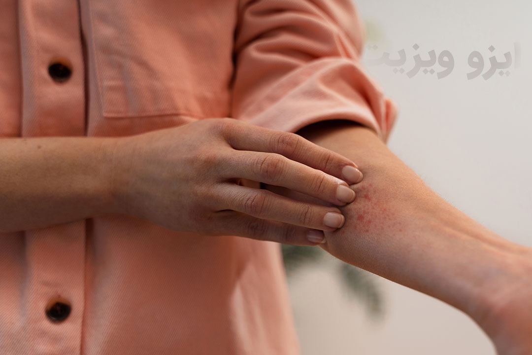 https://dl.isovisit.com/isovisit/uploads/photo-of-the-article-iso-visit-itchy-skin.jpg