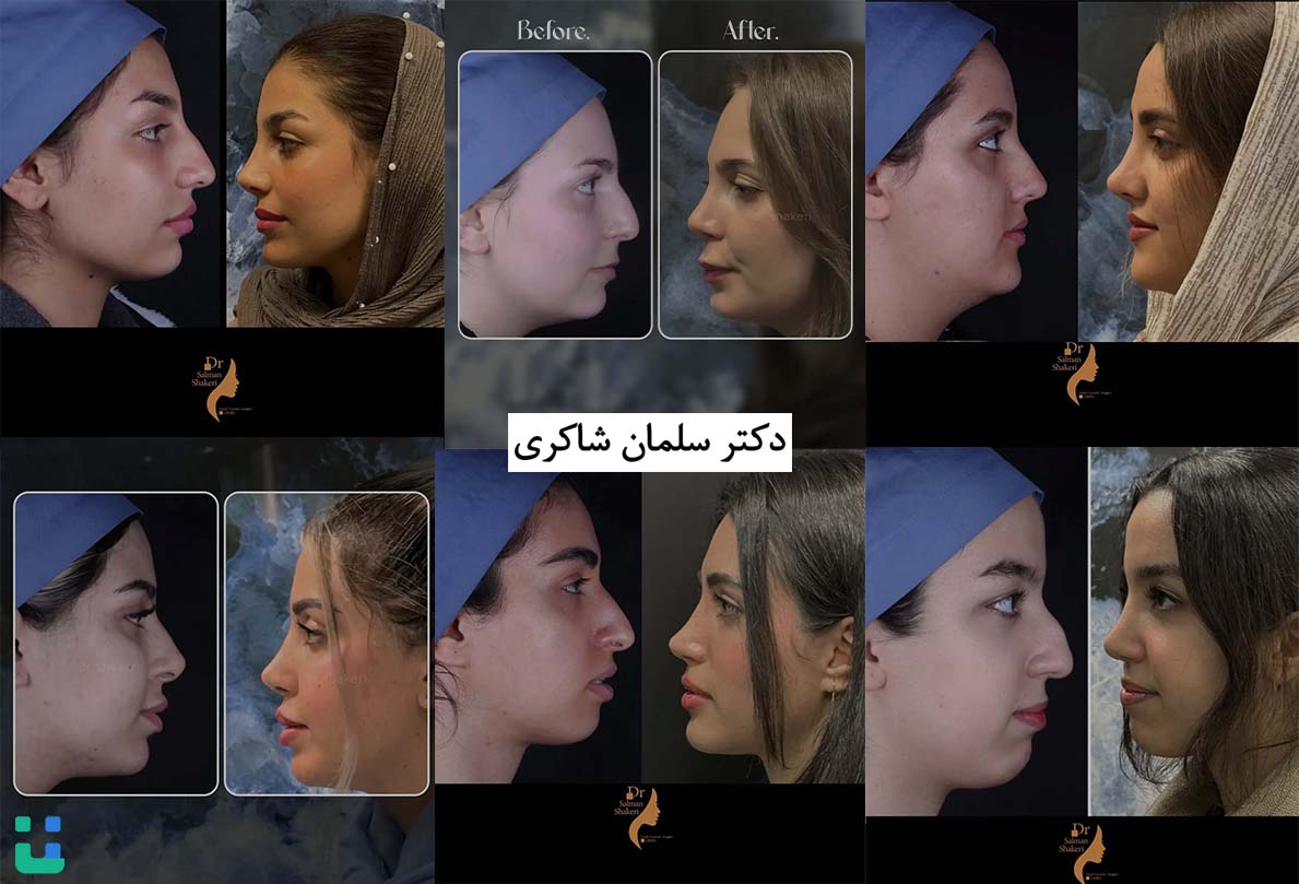 نمونه کارهای عمل بینی دکتر سلمان شاکری