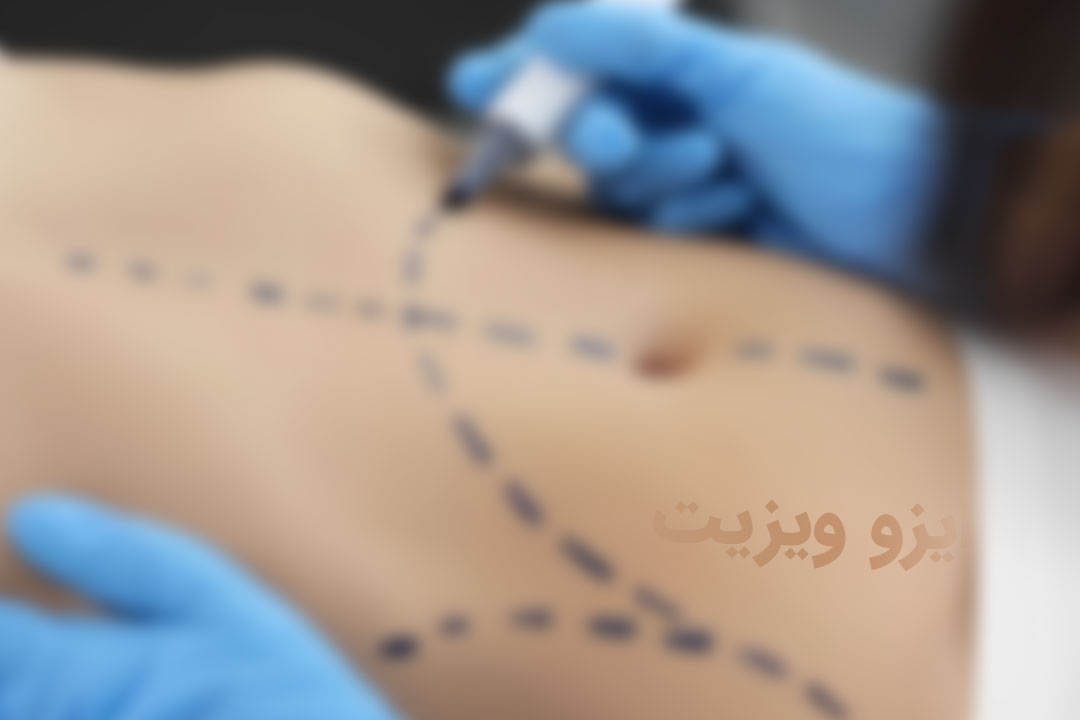 https://dl.isovisit.com/isovisit/uploads/steps-before-abdominoplasty-surgery.jpg