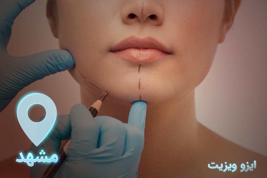 https://dl.isovisit.com/isovisit/uploads/the-best-chin-prosthesis-surgeon-in-mashhad.jpg