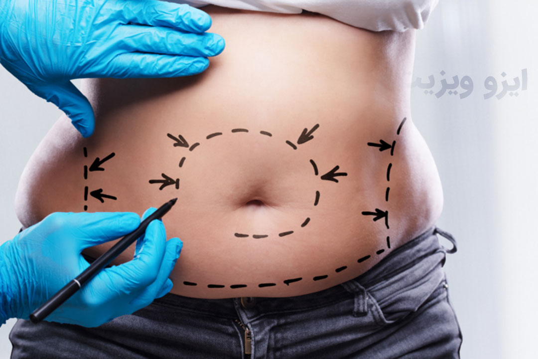 https://dl.isovisit.com/isovisit/uploads/the-most-important-steps-before-liposuction-surgery-2.jpg