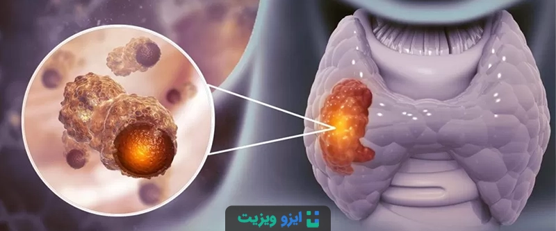 درجات مختلف TI-RADS