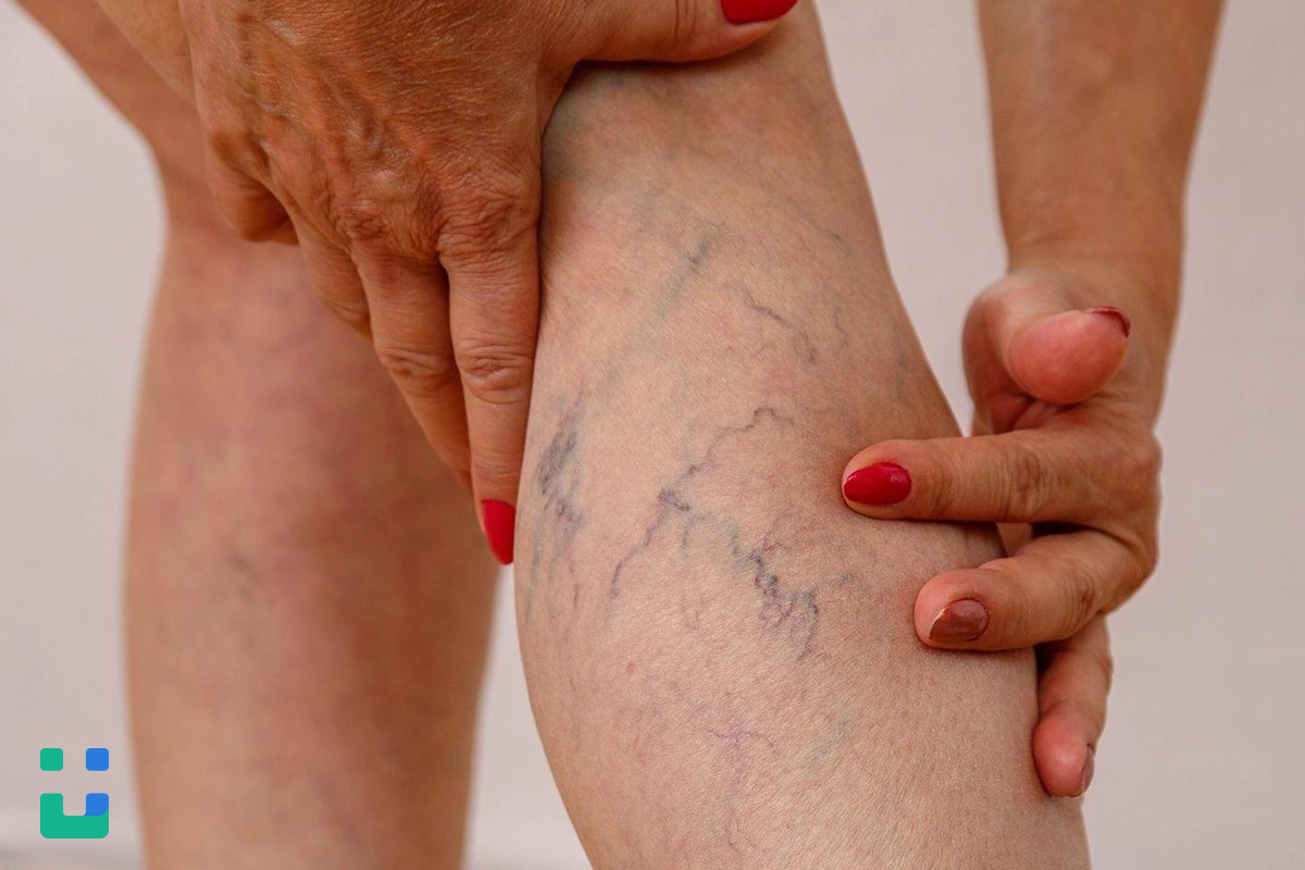 https://dl.isovisit.com/isovisit/uploads/varicose-vein-laser-preoperative-evaluation-isovisit-online-doctor_1792991068.jpg