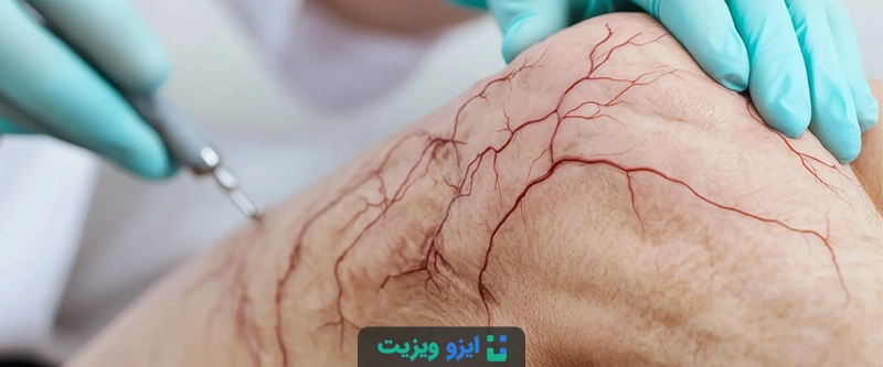 لیزر واریس یک روش درمانی کم&zwnj;تهاجمی، سریع و بسیار مؤثر برای از بین بردن رگ&zwnj;های واریسی و عنکبوتی است