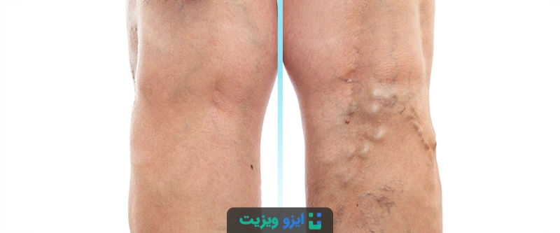 سونوگرافی بعد از لیزر واریس