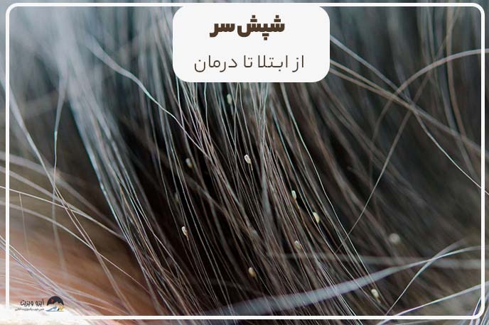 شپش موی سر: از علل ابتلا تا راهکارهای درمان شپش | تیم علمی تحقیقاتی ایزوویزیت