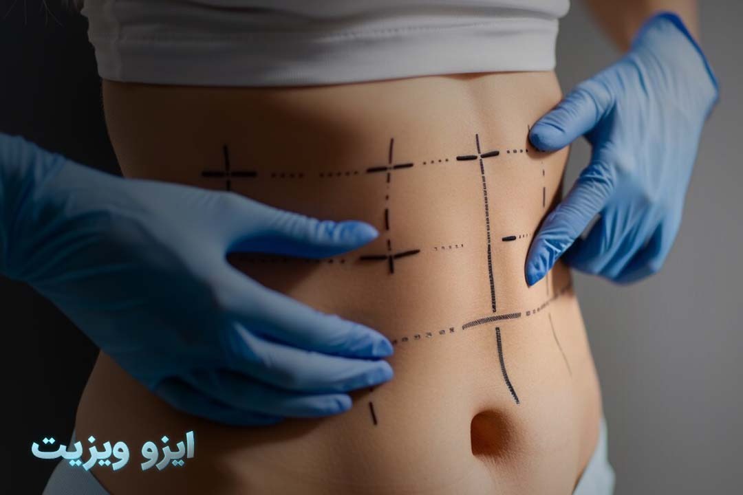 https://dl.isovisit.com/isovisit/uploads/جراحی-ابدومینوپلاستی.jpg