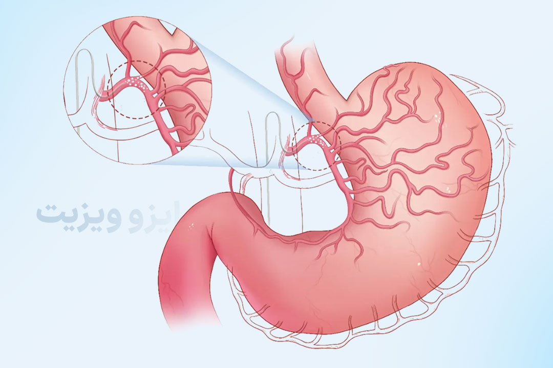 https://dl.isovisit.com/isovisit/uploads/عمل-جراحی-بستن-رگ-اشتها.jpg